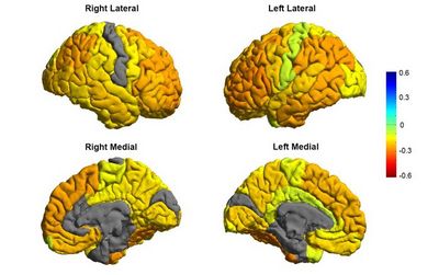Биполярное расстройство связано с утончением коры головного мозга